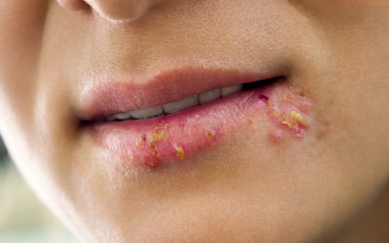 Герпес на губах - причины, лечение