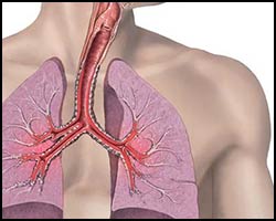 Лечение бронхиальной астмы 