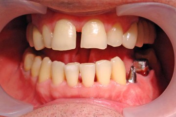 Зубные проблемы