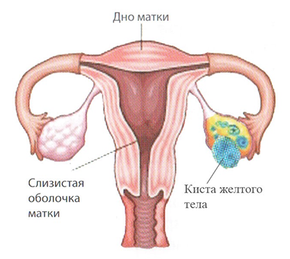 Киста яичника: возможна ли беременность? Диагностика и лечение кисты яичника - АльтраВита